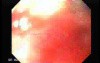 Adenocarcinoma of the Cardias - Endoscopic Maneuvers During Stent Placement
