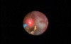Kidney Stone - Laser