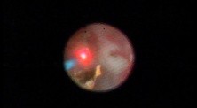 Kidney Stone - Laser