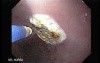 Endoscopic Ablation Of Barrett's Esophagus - 2/6