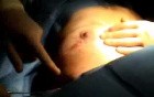 Breast lift