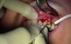 Gingival Grafting, #11 Facial Site - Quick Version