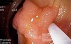 Tubulovillous Adenoma