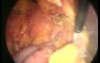 Left Paraduodenal Hernia - Laparoscopic Treatment