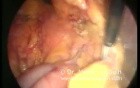 Left Paraduodenal Hernia - Laparoscopic Treatment