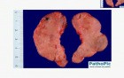 Hashimoto Thyroiditis