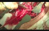 Surgical Disconnection Of Tracheo-Esophageal Fistula