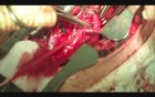 Surgical Disconnection Of Tracheo-Esophageal Fistula