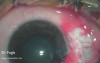 Conjunctival autograft- excision of pterygium