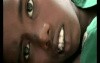 Cholesteatoma Complications