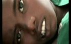 Cholesteatoma Complications