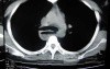 Esophagus - Pneumatic Dilation for Achalasia (30 of 31)