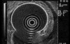 Scirrhous Gastric Carcinoma - Endoscopic Ultrasonography (8 of 15)