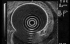 Scirrhous Gastric Carcinoma - Endoscopic Ultrasonography (8 of 15)