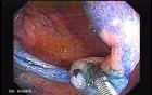 Sessile Tubulovillous Adenoma (8 of 13)