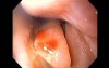 Severe Epistaxis - Case Study  (1 of 8)