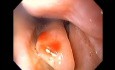 Severe Epistaxis - Case Study  (1 of 8)
