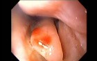 Severe Epistaxis - Case Study  (1 of 8)
