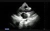 Endocarditis - Mitral Valve Vegetation