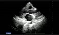 Endocarditis - Mitral Valve Vegetation