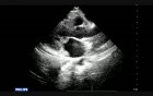 Endocarditis - Mitral Valve Vegetation