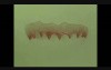 Gingival Mask Prosthetic Artistic Solution - Tissue Regeneration