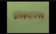 Gingival Mask Prosthetic Artistic Solution - Tissue Regeneration