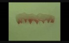 Gingival Mask Prosthetic Artistic Solution - Tissue Regeneration