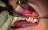 Gingival Grafting, #11 Facial Site - Full Version