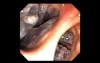 Nasopharynx (10 of 32) Retrograde Endoscopic View