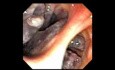 Nasopharynx (10 of 32) Retrograde Endoscopic View