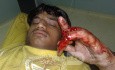 Crush Injury