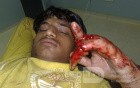 Crush Injury