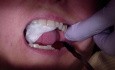 Bridge Insert: Use Vaseline To Check Occlusion.Mp4