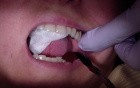 Bridge Insert: Use Vaseline To Check Occlusion.Mp4