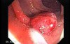 Endoscopic Appearance of Pedicled Polyp of the Descending Colon (4 of 7)