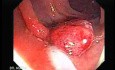 Endoscopic Appearance of Pedicled Polyp of the Descending Colon (4 of 7)