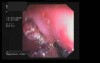 Endoscopic Removing Of Stomach Polyps