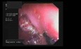 Endoscopic Removing Of Stomach Polyps