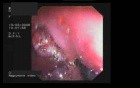 Endoscopic Removing Of Stomach Polyps