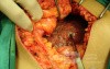 Macronodular Cirrhosi (1 of 2)