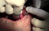 Implant Placements - Implant Surgery, #10-11-12-13 Sites
