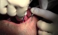 Implant Placements - Implant Surgery, #10-11-12-13 Sites