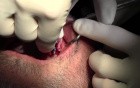 Implant Placements - Implant Surgery, #10-11-12-13 Sites