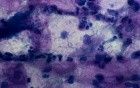 Vaginitis - Streptococcus