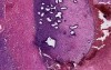Endometriosis - Histopathology of ovary