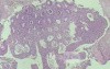 Case on Multiple Adenomas (large polyps) of the Rectum (34 of 37)
