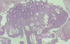 Case on Multiple Adenomas (large polyps) of the Rectum (34 of 37)