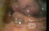 Gastric Fundal Varices