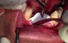 Minimally Invasive Ridge Augmentation